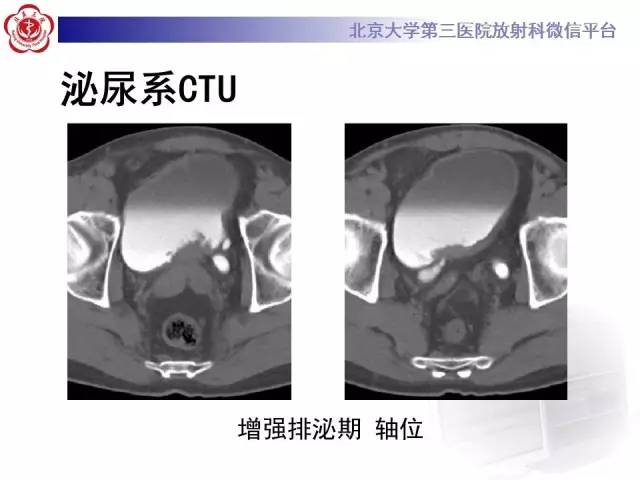 【病例】腺性膀胱炎1例CT影像表现与鉴别