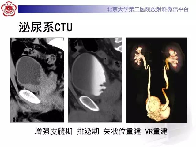 【病例】腺性膀胱炎1例CT影像表现与鉴别
