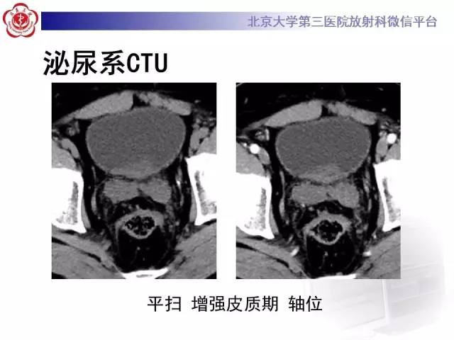【病例】腺性膀胱炎1例CT影像表现与鉴别