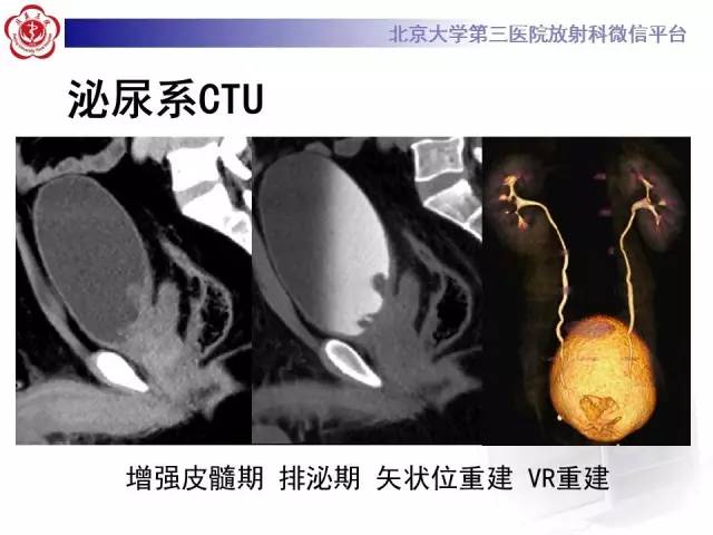 【病例】腺性膀胱炎1例CT影像表现与鉴别