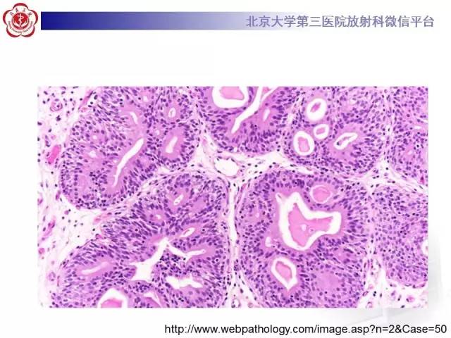 【病例】腺性膀胱炎1例CT影像表现与鉴别