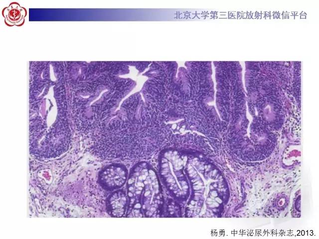 【病例】腺性膀胱炎1例CT影像表现与鉴别