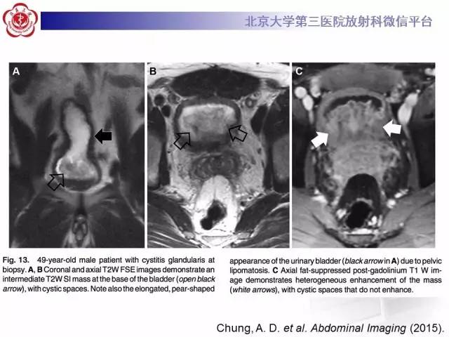【病例】腺性膀胱炎1例CT影像表现与鉴别