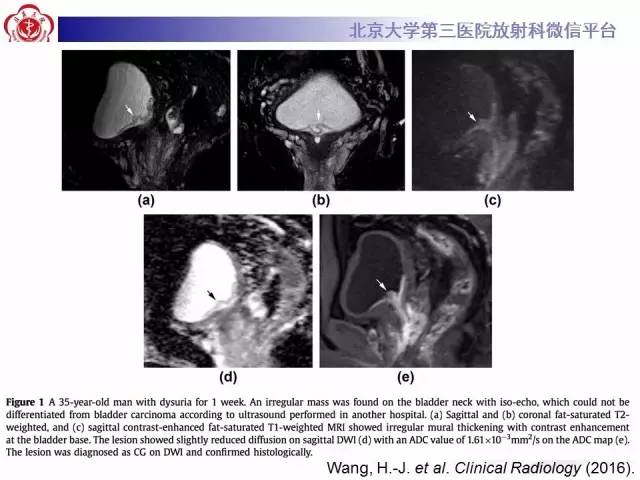 【病例】腺性膀胱炎1例CT影像表现与鉴别