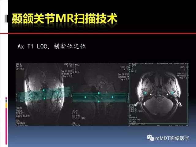 【PPT】颞下颌关节的磁共振成像(检查技术与解剖部分)