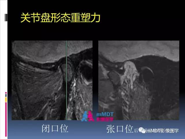 【PPT】颞下颌关节的磁共振成像(检查技术与解剖部分)