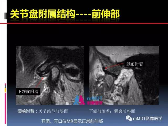 【PPT】颞下颌关节的磁共振成像(检查技术与解剖部分)