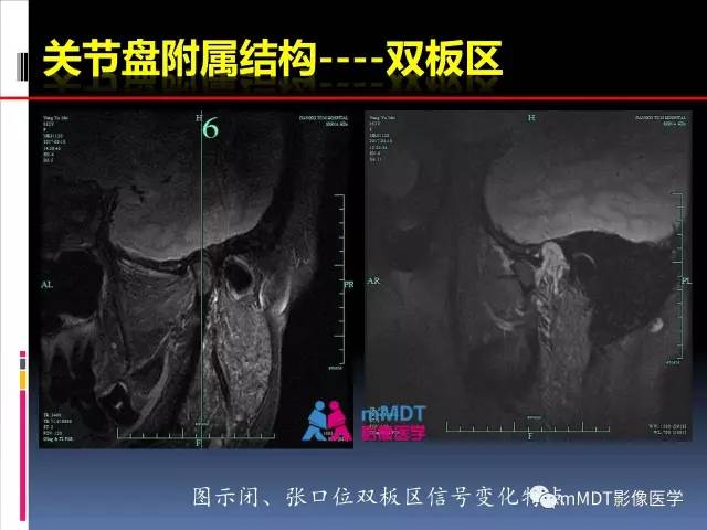 【PPT】颞下颌关节的磁共振成像(检查技术与解剖部分)