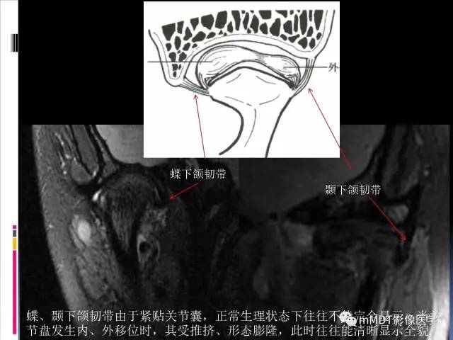 【PPT】颞下颌关节的磁共振成像(检查技术与解剖部分)