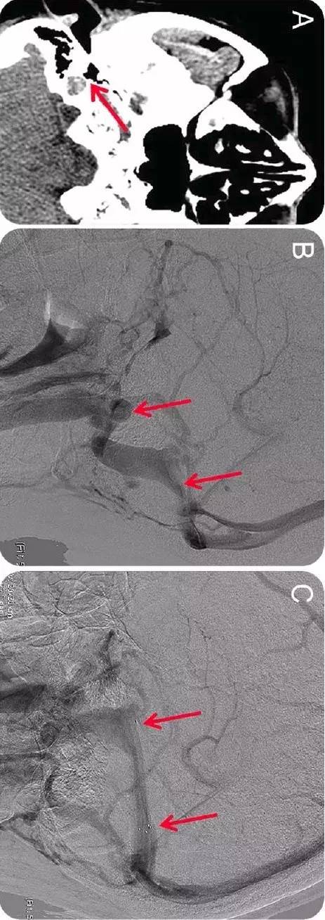 Neurology:静脉窦发育异常是搏动性耳鸣的病因之一 Neurology:静脉窦发育异常是搏动性耳鸣的病因之一