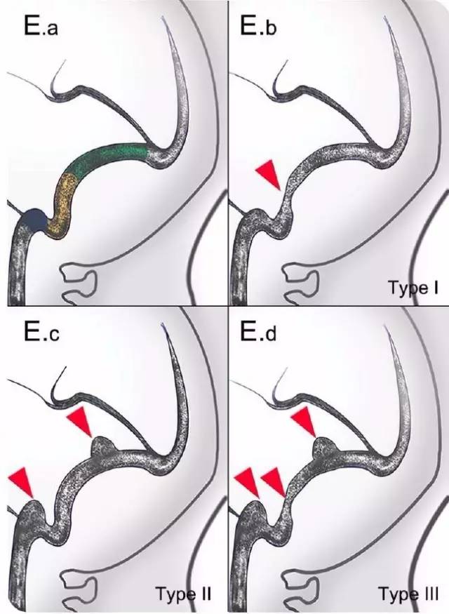 Neurology：静脉窦发育异常是搏动性耳鸣的病因之一