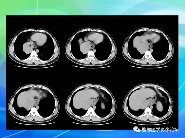 【病例】胃贲门平滑肌瘤1例CT影像表现