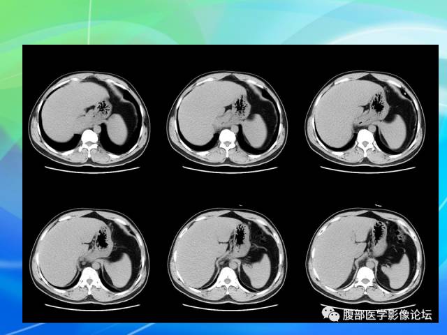 【病例】胃贲门平滑肌瘤1例CT影像表现