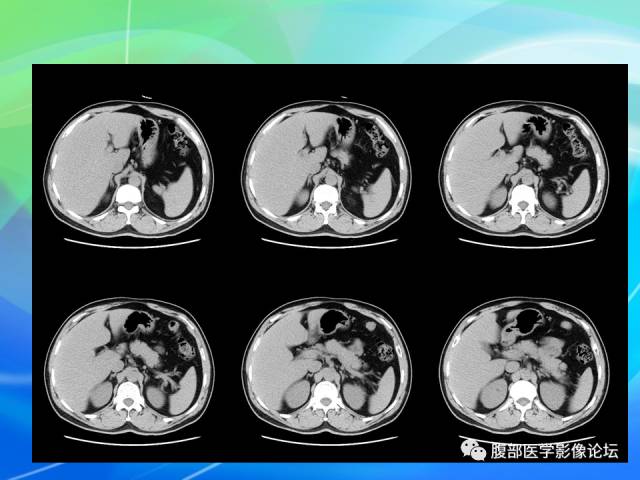 【病例】胃贲门平滑肌瘤1例CT影像表现