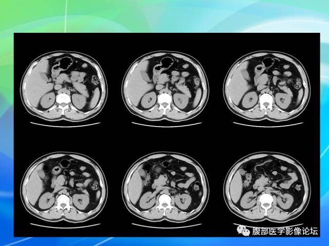 【病例】胃贲门平滑肌瘤1例CT影像表现
