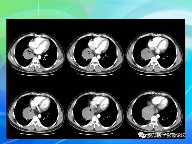 【病例】胃贲门平滑肌瘤1例CT影像表现
