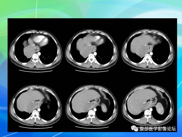 【病例】胃贲门平滑肌瘤1例CT影像表现