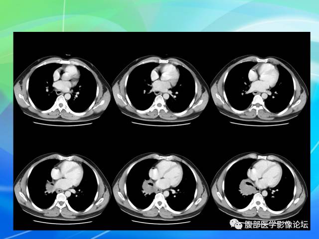 【病例】胃贲门平滑肌瘤1例CT影像表现