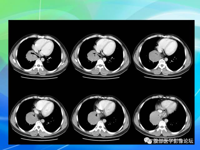 【病例】胃贲门平滑肌瘤1例CT影像表现