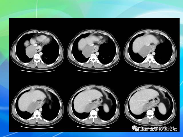【病例】胃贲门平滑肌瘤1例CT影像表现