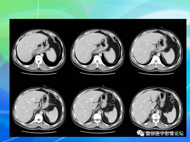 【病例】胃贲门平滑肌瘤1例CT影像表现