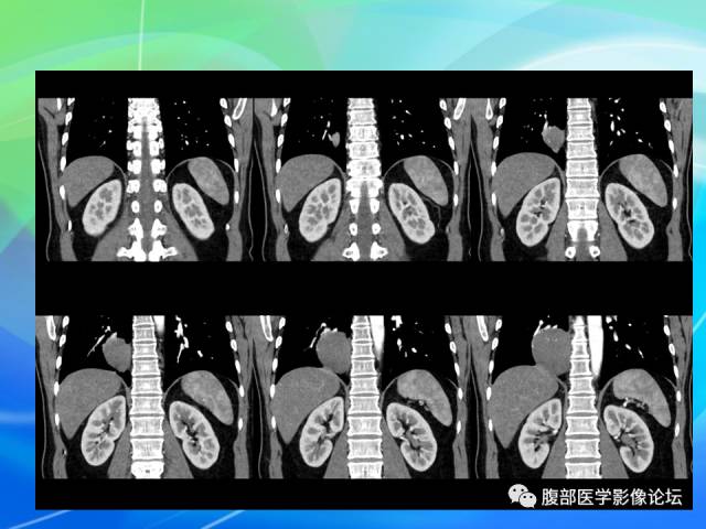 【病例】胃贲门平滑肌瘤1例CT影像表现