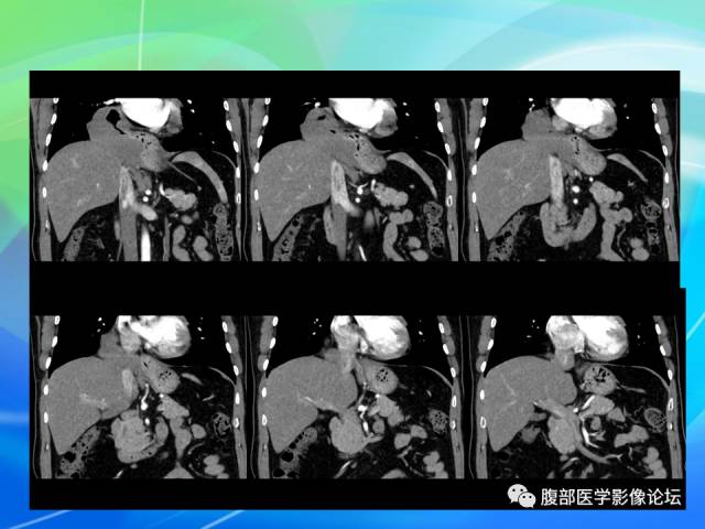 【病例】胃贲门平滑肌瘤1例CT影像表现