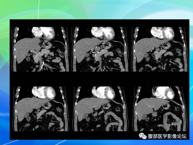 【病例】胃贲门平滑肌瘤1例CT影像表现