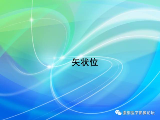 【病例】胃贲门平滑肌瘤1例CT影像表现