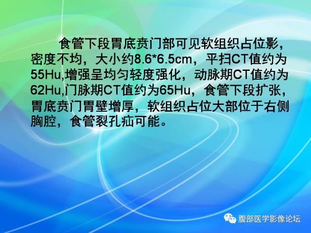 【病例】胃贲门平滑肌瘤1例CT影像表现