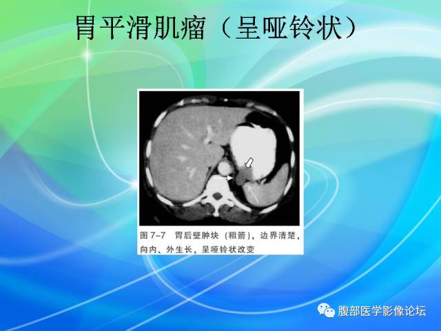 【病例】胃贲门平滑肌瘤1例CT影像表现