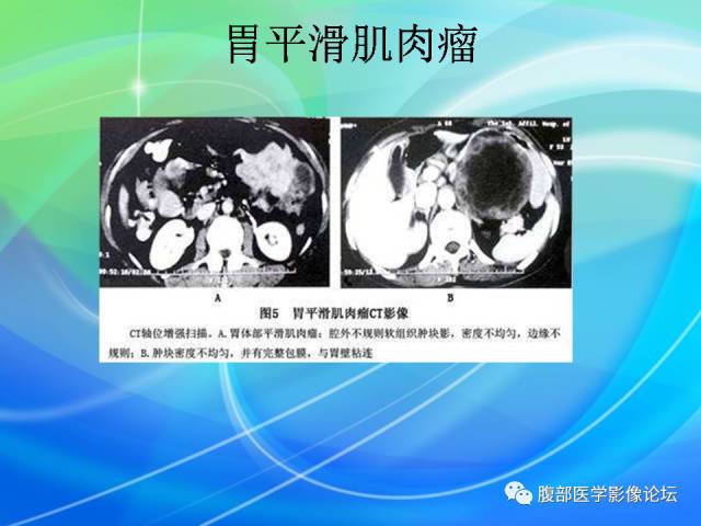 【病例】胃贲门平滑肌瘤1例CT影像表现