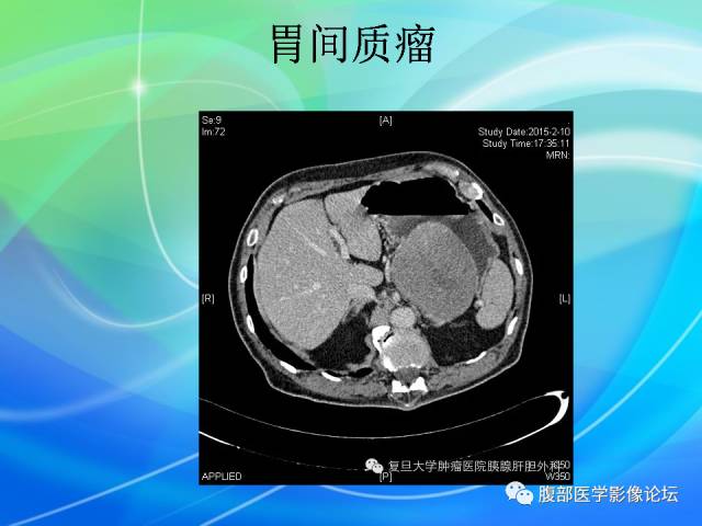 【病例】胃贲门平滑肌瘤1例CT影像表现