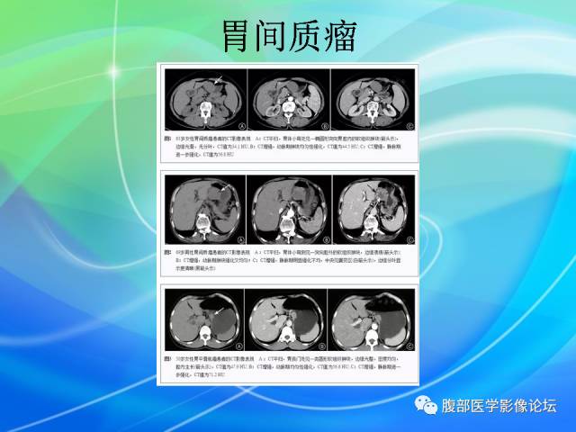 【病例】胃贲门平滑肌瘤1例CT影像表现