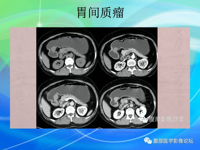 【病例】胃贲门平滑肌瘤1例CT影像表现