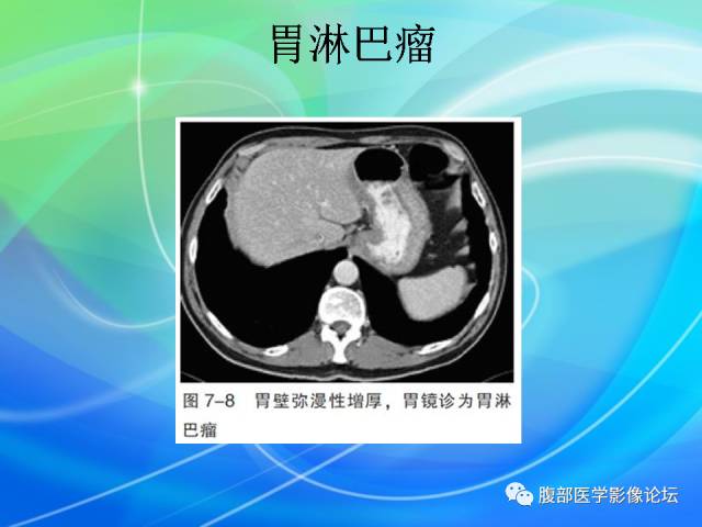 【病例】胃贲门平滑肌瘤1例CT影像表现