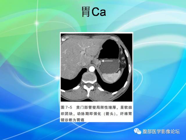 【病例】胃贲门平滑肌瘤1例CT影像表现