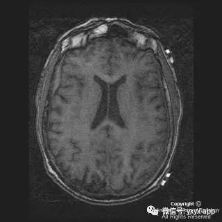 【病例】硬脑膜浆细胞瘤1例MR影像表现 【病例】硬脑膜浆细胞瘤1例MR影像表现