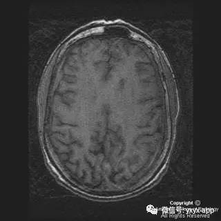 【病例】硬脑膜浆细胞瘤1例MR影像表现 【病例】硬脑膜浆细胞瘤1例MR影像表现