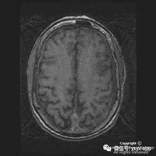 【病例】硬脑膜浆细胞瘤1例MR影像表现 【病例】硬脑膜浆细胞瘤1例MR影像表现