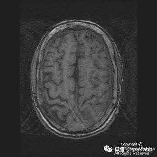 【病例】硬脑膜浆细胞瘤1例MR影像表现 【病例】硬脑膜浆细胞瘤1例MR影像表现