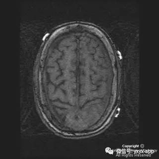 【病例】硬脑膜浆细胞瘤1例MR影像表现 【病例】硬脑膜浆细胞瘤1例MR影像表现
