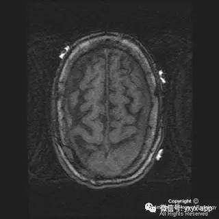 【病例】硬脑膜浆细胞瘤1例MR影像表现 【病例】硬脑膜浆细胞瘤1例MR影像表现