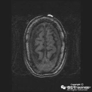 【病例】硬脑膜浆细胞瘤1例MR影像表现 【病例】硬脑膜浆细胞瘤1例MR影像表现