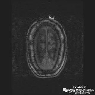 【病例】硬脑膜浆细胞瘤1例MR影像表现 【病例】硬脑膜浆细胞瘤1例MR影像表现