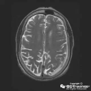 【病例】硬脑膜浆细胞瘤1例MR影像表现 【病例】硬脑膜浆细胞瘤1例MR影像表现