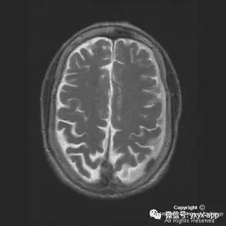 【病例】硬脑膜浆细胞瘤1例MR影像表现 【病例】硬脑膜浆细胞瘤1例MR影像表现