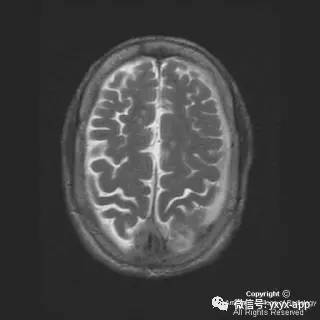 【病例】硬脑膜浆细胞瘤1例MR影像表现 【病例】硬脑膜浆细胞瘤1例MR影像表现