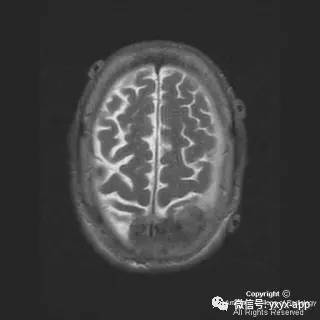 【病例】硬脑膜浆细胞瘤1例MR影像表现 【病例】硬脑膜浆细胞瘤1例MR影像表现