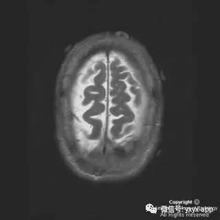 【病例】硬脑膜浆细胞瘤1例MR影像表现 【病例】硬脑膜浆细胞瘤1例MR影像表现